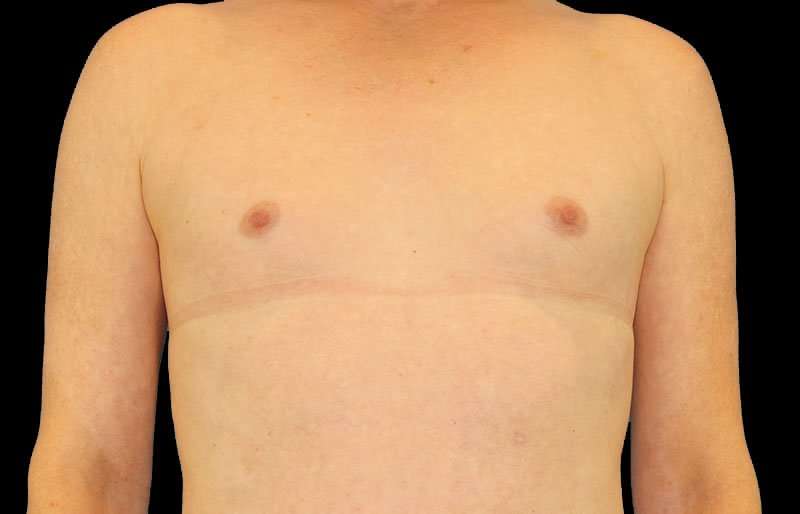 MTF Breast Augmentation Before & After Patient #1820