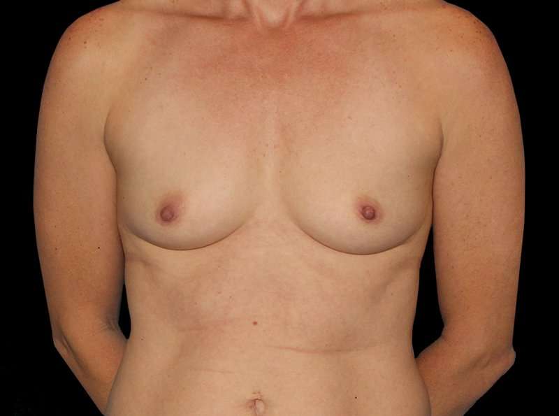 Breast Augmentation - Implant Before & After Patient #968