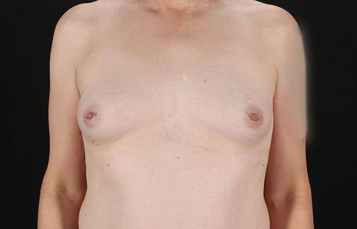 MTF Breast Augmentation Before & After Patient #1831