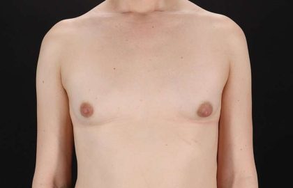 MTF Breast Augmentation Before & After Patient #1842