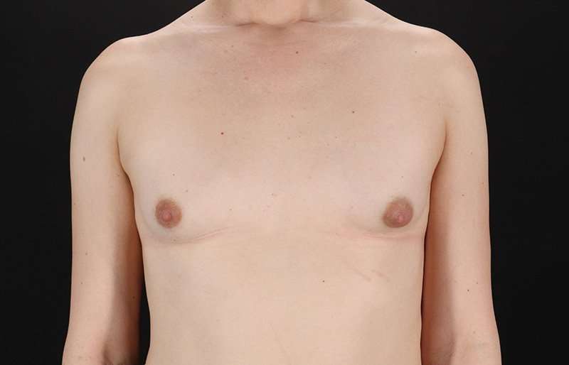 MTF Breast Augmentation Before & After Patient #1842