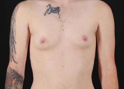 FTM Chest Contouring Before & After Patient #1864