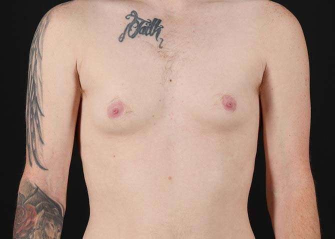 FTM Chest Contouring Before & After Patient #1864