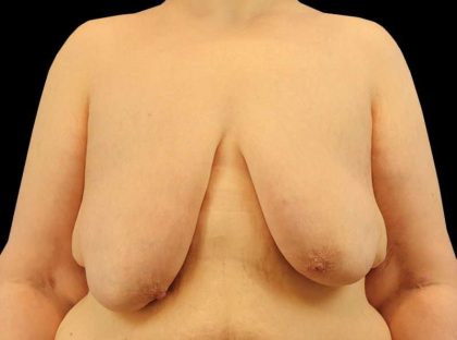 FTM Chest Contouring Before & After Patient #1875