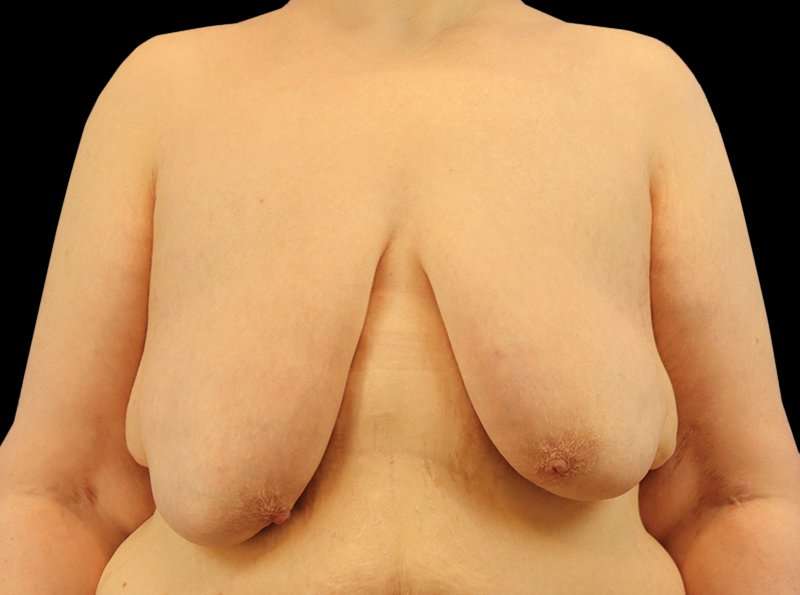 FTM Chest Contouring Before & After Patient #1875