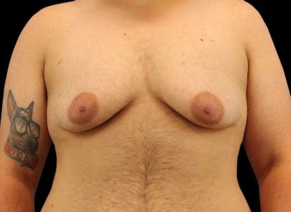 FTM Chest Contouring Before & After Patient #1886