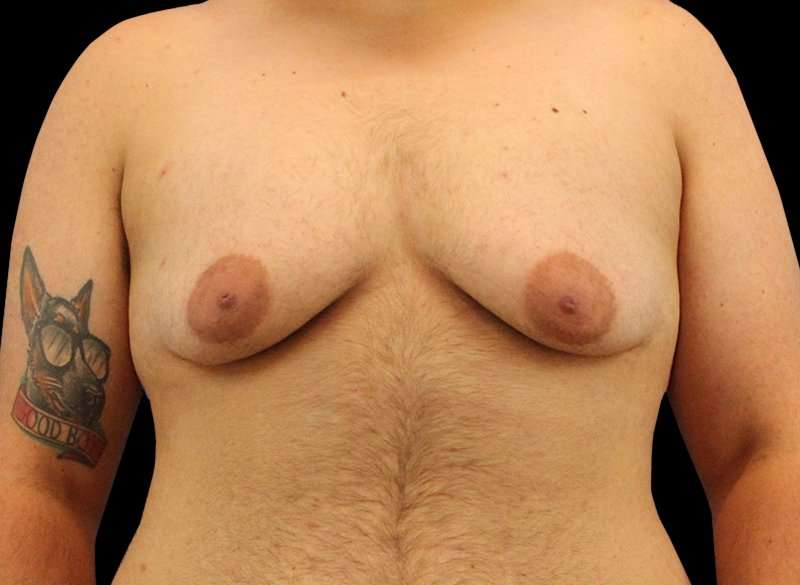FTM Chest Contouring Before & After Patient #1886