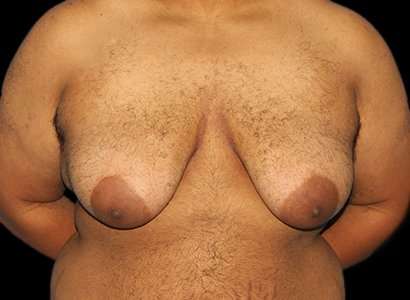 FTM Chest Contouring Before & After Patient #1893