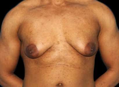 FTM Chest Contouring Before & After Patient #1907
