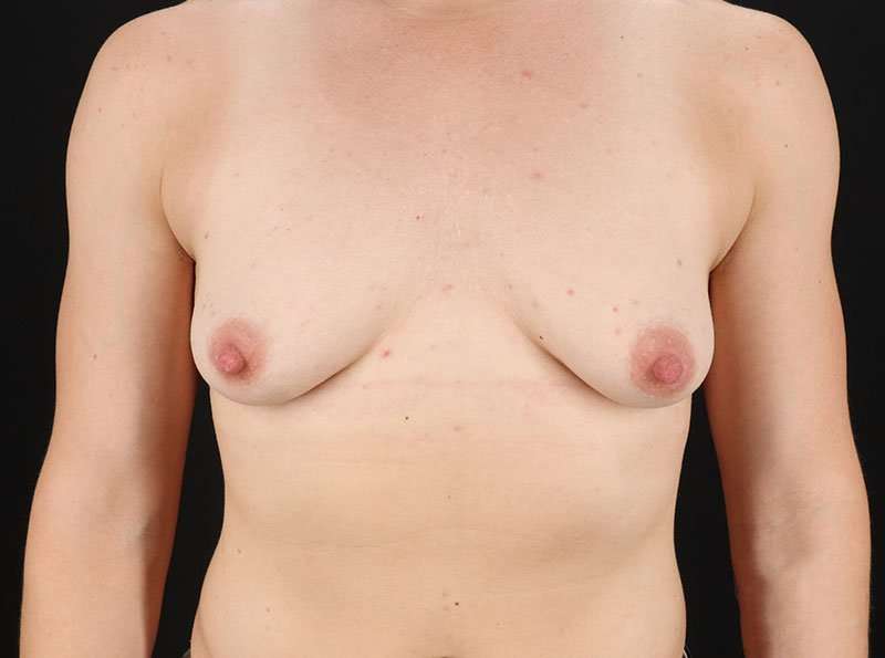 FTM Chest Contouring Before & After Patient #1918