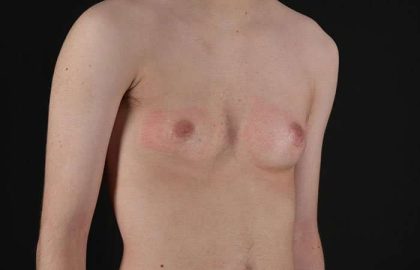 FTM Chest Contouring Before & After Patient #1940