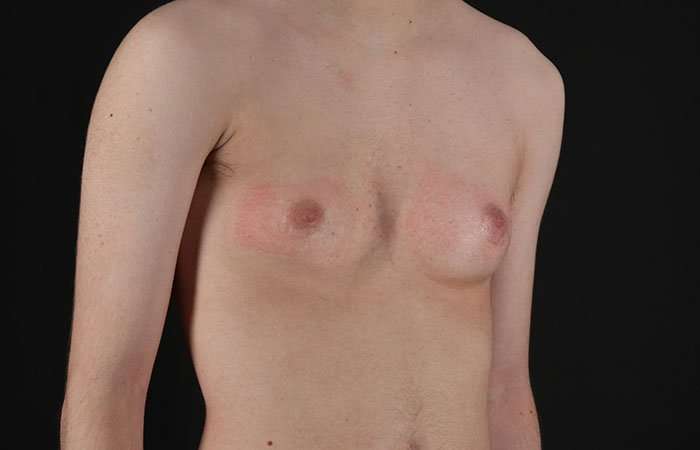 FTM Chest Contouring Before & After Patient #1940