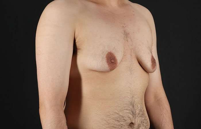FTM Chest Contouring Before & After Patient #1951