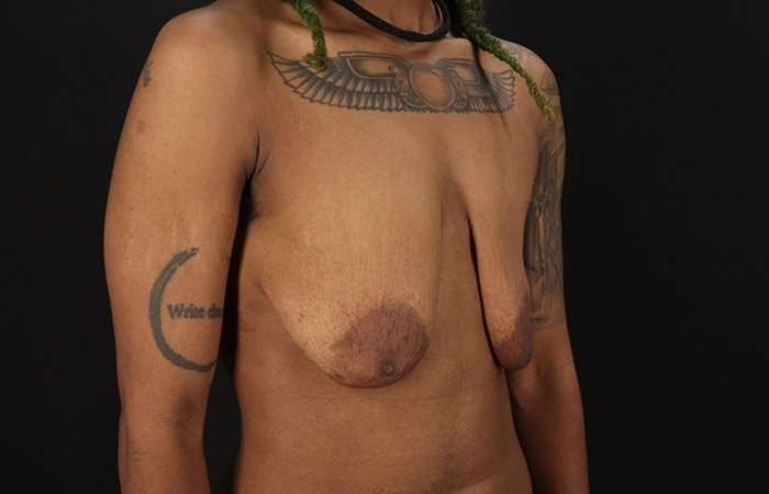 FTM Chest Contouring Before & After Patient #1962