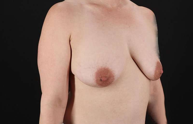 FTM Chest Contouring Before & After Patient #1973