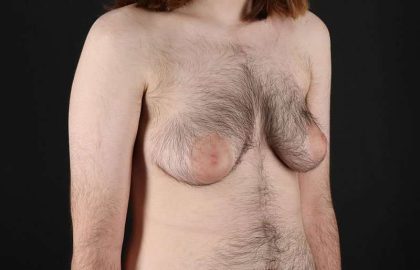 FTM Chest Contouring Before & After Patient #1984