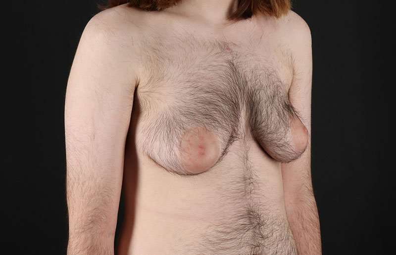 FTM Chest Contouring Before & After Patient #1984