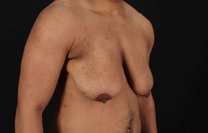 FTM Chest Contouring Before & After Patient #1995