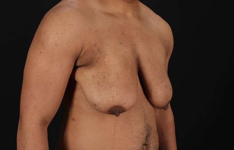 FTM Chest Contouring Before & After Patient #1995