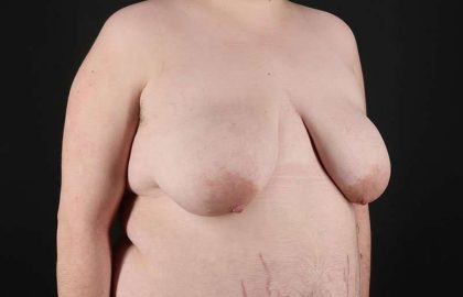 FTM Chest Contouring Before & After Patient #2006