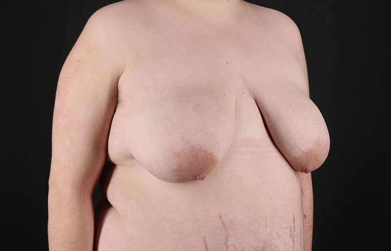 FTM Chest Contouring Before & After Patient #2006