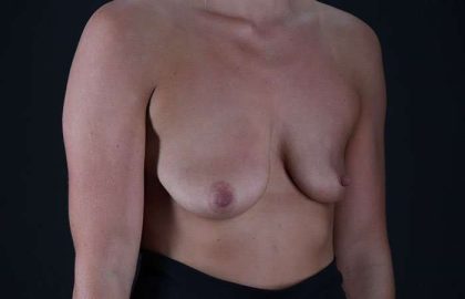 Breast Augmentation - Implant Before & After Patient #990