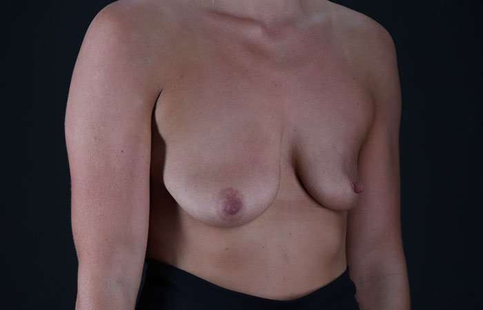 Breast Augmentation - Implant Before & After Patient #990