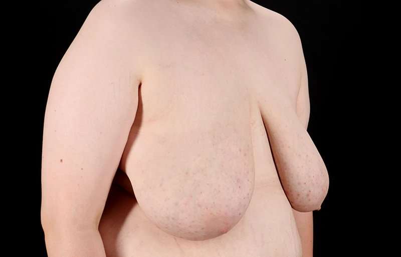 FTM Chest Contouring Before & After Patient #2039