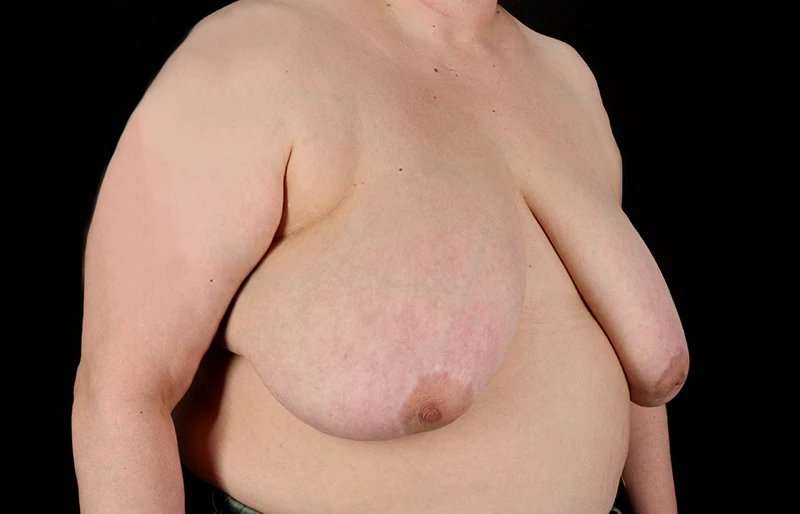 FTM Chest Contouring Before & After Patient #2050
