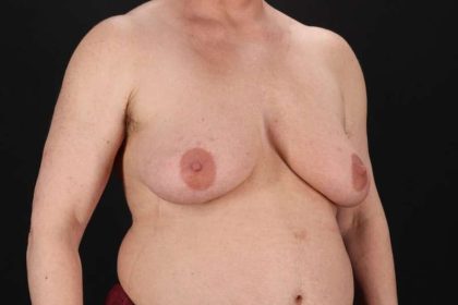 FTM Chest Contouring Before & After Patient #2061