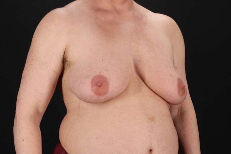 FTM Chest Contouring Before & After Patient #2061
