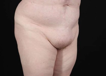 Monsplasty Before & After Patient #2106