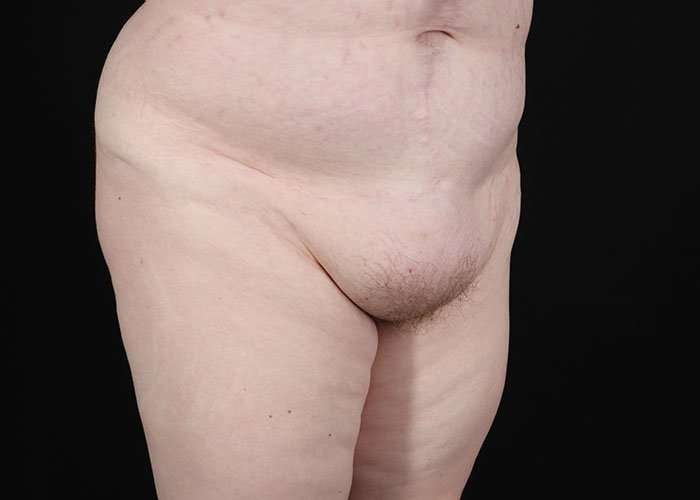 Monsplasty Before & After Patient #2106