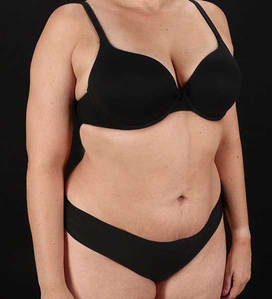 Tummy Tuck Before & After Patient #2128