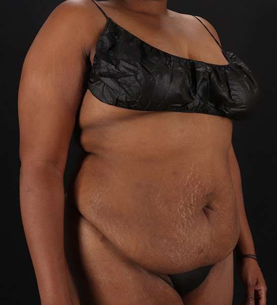 Tummy Tuck Before & After Patient #2146