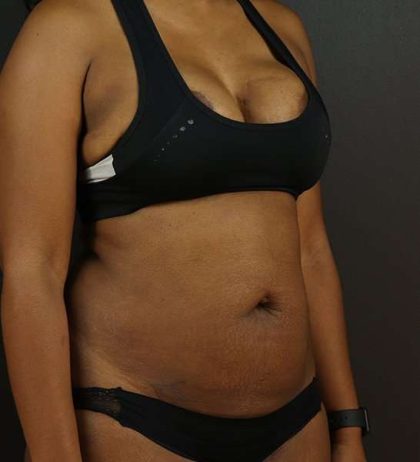 Tummy Tuck Before & After Patient #2168