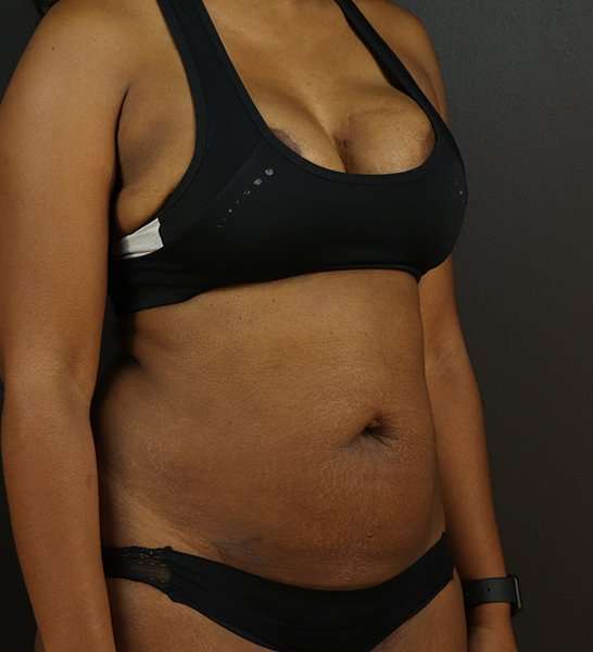 Tummy Tuck Before & After Patient #2168