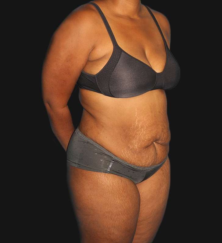 Tummy Tuck Before & After Patient #2179