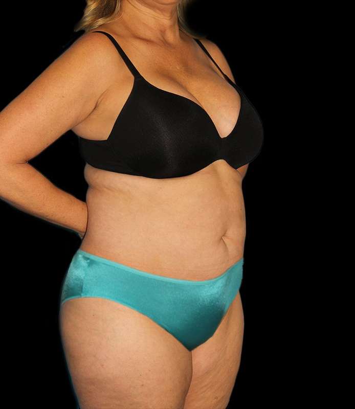 Tummy Tuck Before & After Patient #2190