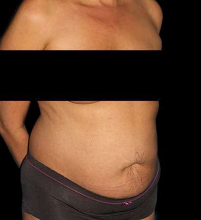 Tummy Tuck Before & After Patient #2201