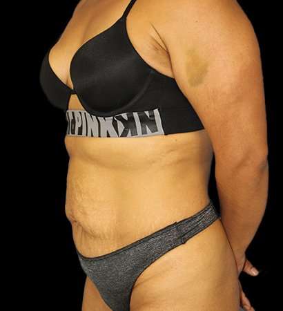 Tummy Tuck Before & After Patient #2212