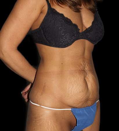 Tummy Tuck Before & After Patient #2269