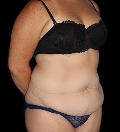 Tummy Tuck Before & After Patient #2280