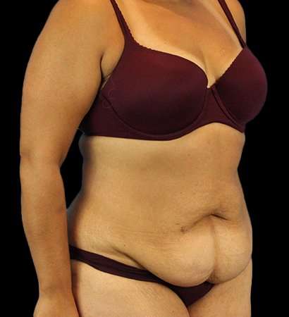 Tummy Tuck Before & After Patient #2291