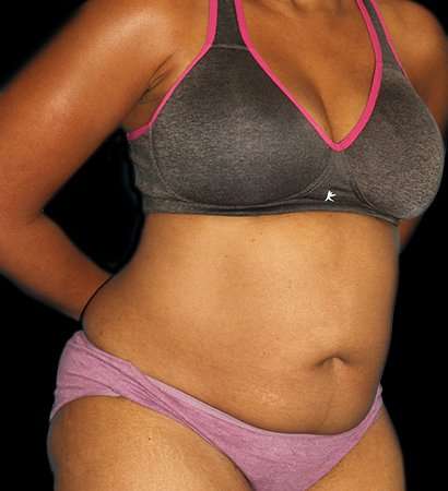 Tummy Tuck Before & After Patient #2302