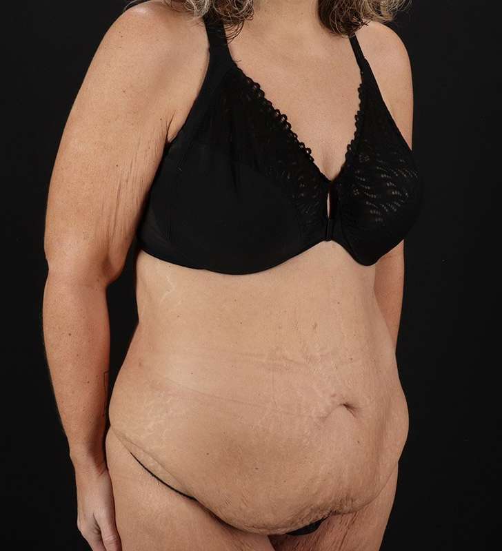 Tummy Tuck Before & After Patient #2326