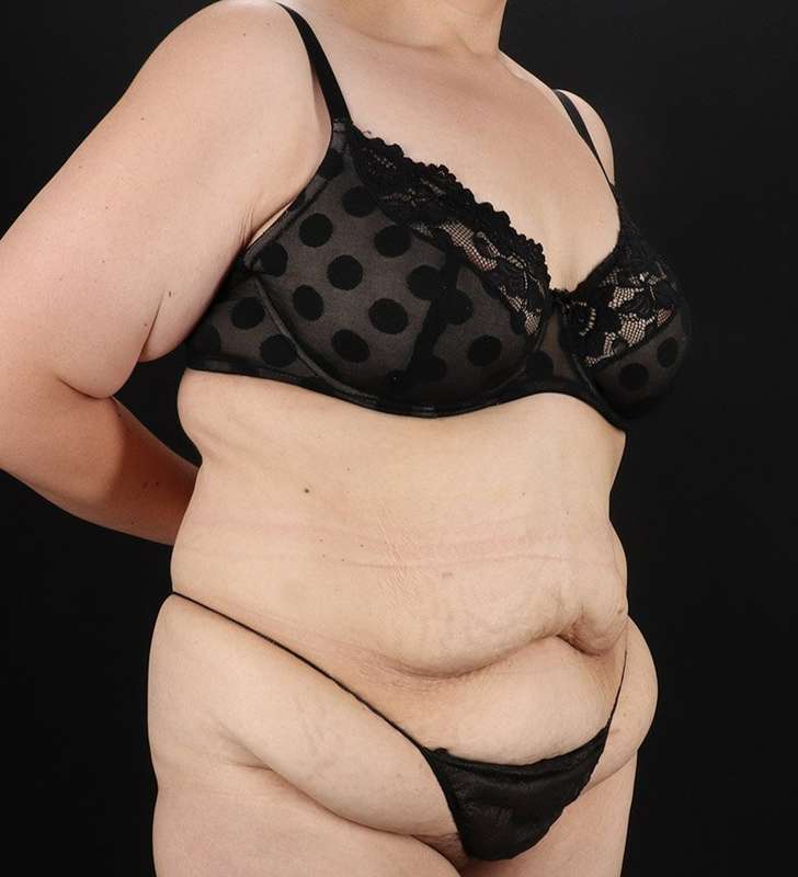 Tummy Tuck Before & After Patient #2339