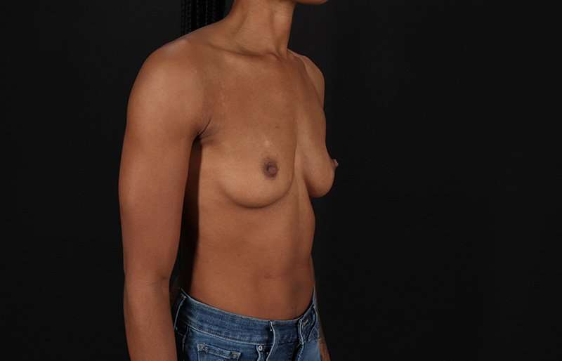 Breast Augmentation - Implant Before & After Patient #1023