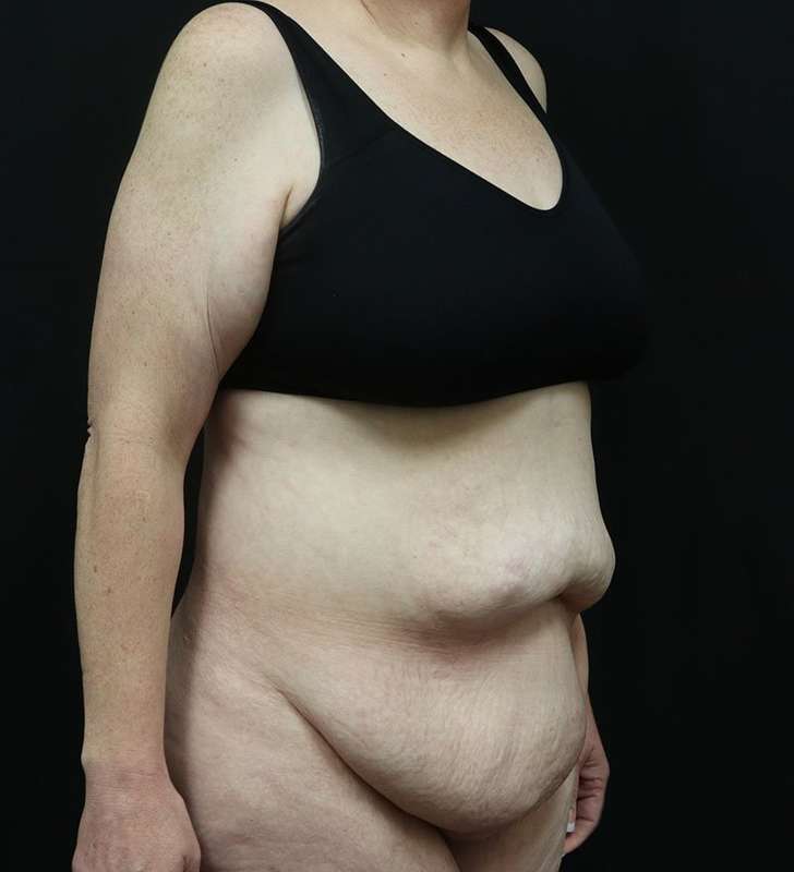 Tummy Tuck Before & After Patient #2363
