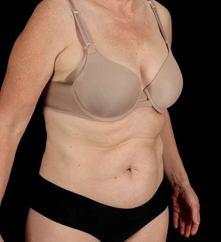 Tummy Tuck Before & After Patient #2435